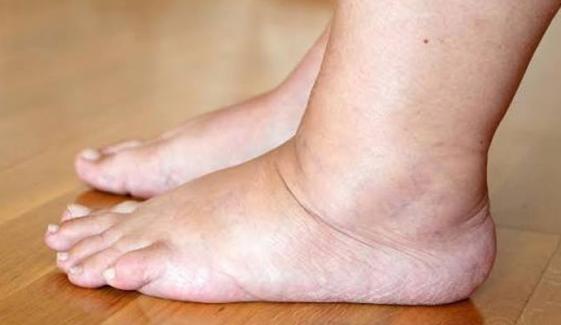 صرف 10 منٹ میں پاؤں کی سوجن کم اور ذہنی تناؤ سے نجات کا آسان طریقہ