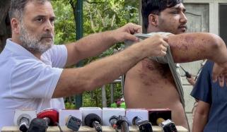 راہول گاندھی نے پیلٹ گن سے زخمی نوجوان کو میڈیا کے سامنے پیش کر دیا