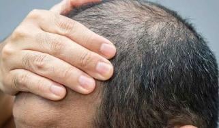 وزن کم کرنے اور ذیابیطس کی ادویات سے بال جھڑنے کا خطرہ بڑھ سکتا ہے: تحقیق