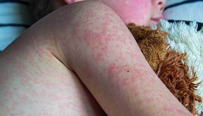 US measles crisis deepens as two unvaccinated people die in Pennsylvania