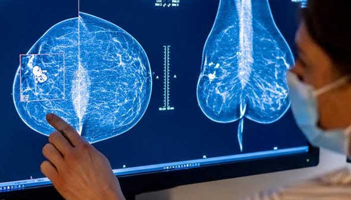AI cleared to review mammograms without radiologists, raising job concerns