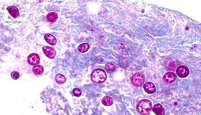 US declares largest Cyclospora outbreak over after 12,000 cases