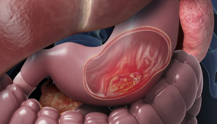 Know these stomach cancer warning signs before it’s too late