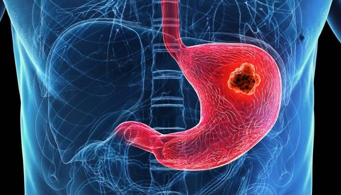 8 silent warning signs of stomach cancer you should never ignore